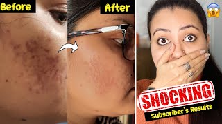 Subscribers Magical Skincare Challenge  Strongest Remedy To Remove Dark SpotsAcne Pimples Marks💕 [upl. by Karim]