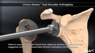 Univers Revers™ Total Shoulder Arthroplasty [upl. by Nedia]