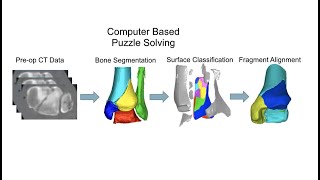 Pilon Fractures Dr Jamal al Asiri FRCSC [upl. by Beata]