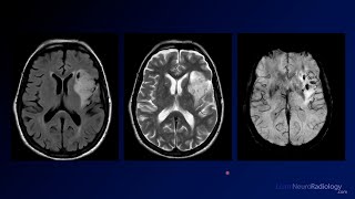 Neuroradiology Board Review  Brain Tumors  Case 17 [upl. by Nyliram5]