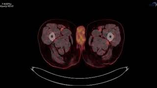 PSMA PETCT F18 Pylarify Case 6 [upl. by Syned]