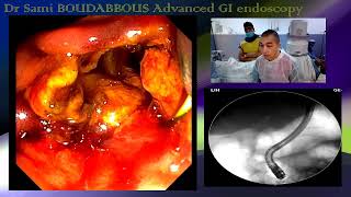 ERCP FOR ACUTE CHOLANGITIS [upl. by Tenn]