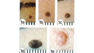 Skin Cancer amp Raised or Elevated Moles  Skin Cancer [upl. by Yeldnarb291]