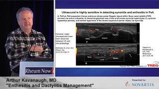 RNL 2021  Enthesitis amp Dactylitis Management Dr Arthur Kavanaugh [upl. by Mello568]