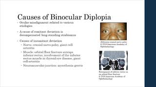 Binocular vs Monocular Diplopia [upl. by Savvas]