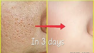 Remove Face holes fast naturally  get clear skin naturally  hole less skin [upl. by Akenehs]