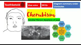 Cherubism DETAILED  fibroosseous lesions  Oral pathology  NEET MDSBDS with Diagrams Shafers [upl. by Akcirre]