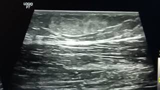 subcutaneous lipoma ultrasound case [upl. by Lise]