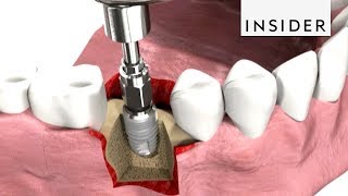 How Dentists Insert Dental Implants [upl. by Ferrigno569]