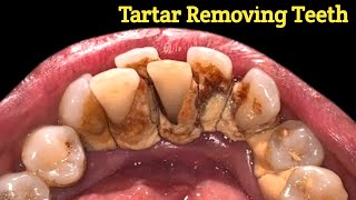 Best tartar removal Ive ever seen  tartar removing  tartar [upl. by Yatnuahs]