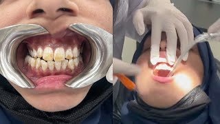 Step By Step Guide To Fluorosis Treatment  Dental Procedure Video [upl. by Assillem702]