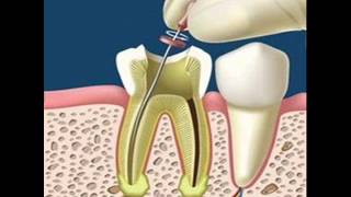 Absceso alveolar crónico Diagnóstico y tratamiento [upl. by Pauly]