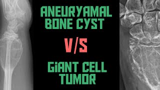 Giant Cell Tumor VS Aneurysmal Bone cyst  GCT VS ABC  Xrays  Image bases  Radiology [upl. by Eliot]