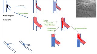 Ostial side branch stenting esp ostial diagonal algorithms and cases Elias Hanna [upl. by Leavy]