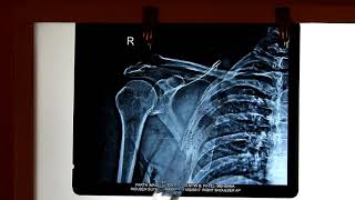 Radiological Anatomy of Upper limb [upl. by Ylyl121]