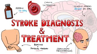 Stroke Diagnosis and Treatment  Acute and Long Term Treatment of Ischemic and Hemorrhagic Stroke [upl. by Bridget]