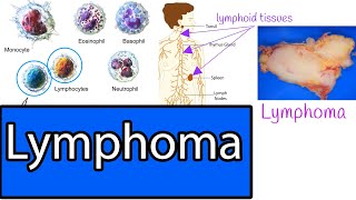 Lymphoma  Types Most common Lymphomas Symptoms and treatment [upl. by Lara]