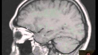 MRI Brain Abscess  Anatomy DISCUSSION [upl. by Nauqaj]