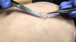 How to remove a running suture [upl. by Ativ]