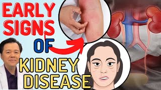 Early Signs of Kidneys Disease  By Doc Willie Ong Internist and Cardiologist [upl. by Drusy]