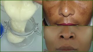 IN 7 DAYS REMOVE DARK SPOTS AND SCARS PERMANENT DARK SPOTS  SCARS REMOVER CREAM Khichi Beauty [upl. by Nohshan]