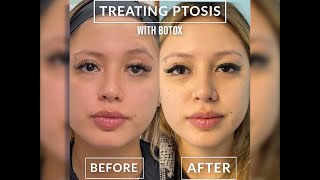 Treating Ptosis With Botox [upl. by Elicul]