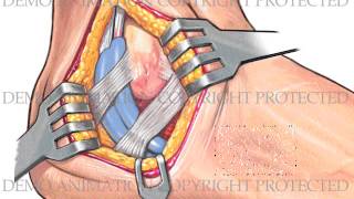 Ankle Arthroscopy and Open Repair [upl. by Draude]