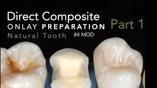 Direct Composite Onlay Part 1 Preparation  4 MOD Natural Tooth [upl. by Godwin]