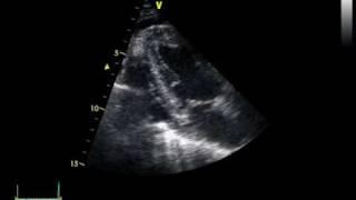 CHRONIC PERICARDITIS with thickening of the pericardium [upl. by Yelrehs891]