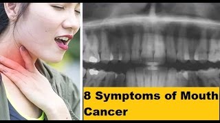 8 Symptoms of Mouth Cancer That You Need To Know Before [upl. by Yrneh]