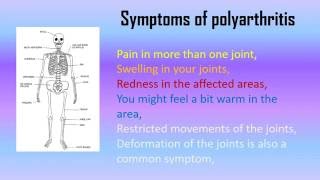 What is Polyarthritis Symptoms and Treatment  Hooolcom [upl. by Ainosal]