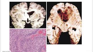 TUMORS Of CNS  Gliomas Astrocytoma  Oligodendroglioma  Midline Glioma  Ependymoma [upl. by Idnic]