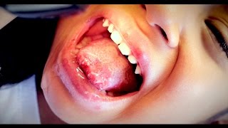 BAD TONGUE SORES Herpes Stomatitis  Dr Paul [upl. by Renner]