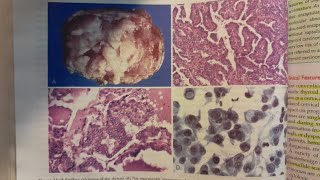 Papillary Thyroid Carcinoma  SPECIAL PATHOLOGY [upl. by Korwun]