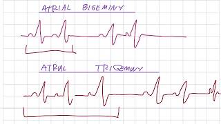 EKG 38  Premature Atrial Beats [upl. by Morgun745]