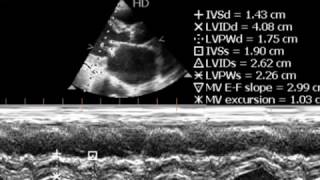 ASARMS RHD ECHOCARDIOGRAPHY SERIES BY DRANKUR KCHAUDHARI [upl. by Ambler]