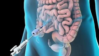 Laparoscopic Lysis of Abdominal Adhesions 2011 [upl. by Thorvald]