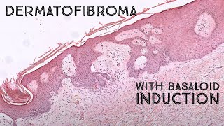 Dermatofibroma with basaloid follicular induction mimic of basal cell carcinoma pathology [upl. by Eenehs]