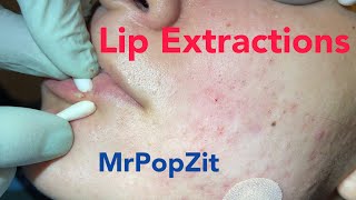 Lip extractions Whiteheads blackheads acne extractions on face Inflammatory pustules [upl. by Brandise]