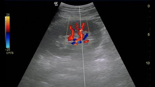 Renal Doppler Ultrasound [upl. by Rasia]