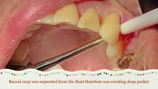 How To Diagnose Vertical Root Fractured Tooth [upl. by Ahsikit386]