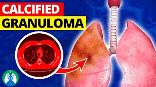 What is a Calcified Granuloma in the Lungs [upl. by Labotsirhc]