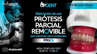 Elaboración de una Prótesis Parcial Removible para solucionar casos complicados [upl. by Ma729]