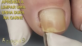 VOCÊS NÃO VÃO ACREDITAR NO QUE O FUNGO FEZ NESSA UNHA LINDA  Granuloma de grau I satisfying viral [upl. by Atener462]