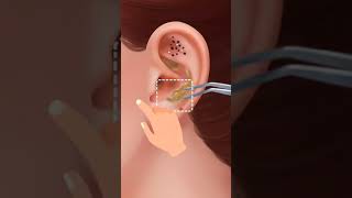 Clean your ears using ear cleaner animation [upl. by Bikales]