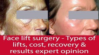 Face Lift Surgery – Types of Lifts Cost Recovery amp Results  Dr Debraj Shome [upl. by Nappie]