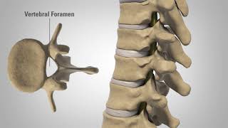 Myelopathy  Patient Education [upl. by Ecertap473]