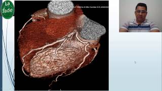Angiotomografia de coronárias [upl. by Gentille]