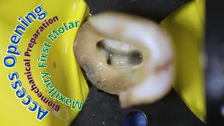 access opening 🟢 maxillary first molar 🔵 [upl. by Joni670]