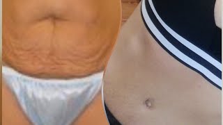 Avant abdominoplastie et après abdominoplastie [upl. by Nevar412]